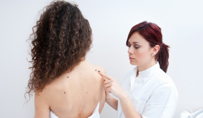 Pericolele la care te expui atunci când îţi îndepărtezi singur negii şi papiloamele Pericolele la care te expui atunci când îţi îndepărtezi singur negii şi papiloamele