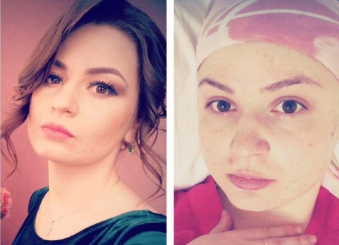„Vreau să trăiesc”: Povestea unei tinere în vârstă de 24 de ani care a fost diagnosticată cu leucemie „Vreau să trăiesc”: Povestea unei tinere în vârstă de 24 de ani care a fost diagnosticată cu leucemie
